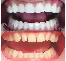 Dentist applying cosmetic filling to patient tooth at DCDC