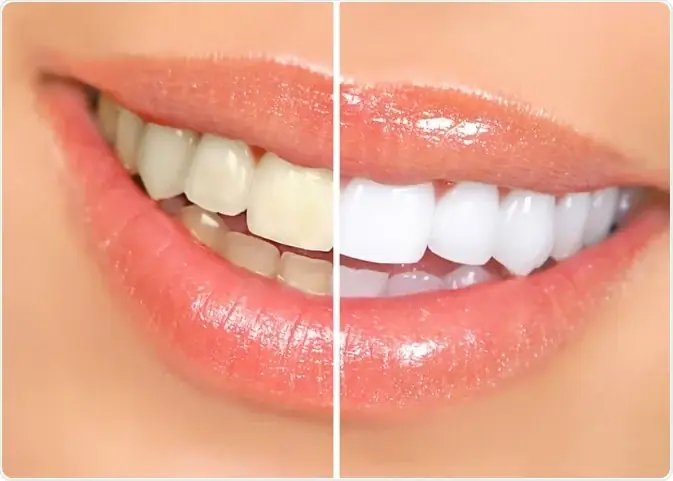 Patient undergoing professional teeth whitening at DCDC Dubai