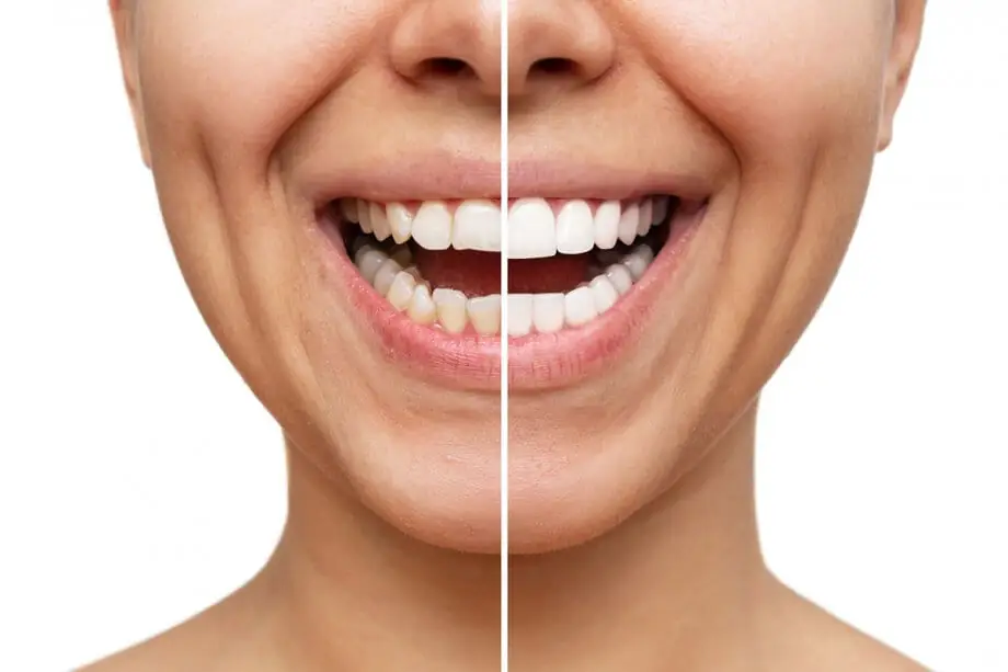 Porcelain Veneers procedure at DCDC Dubai Healthcare City