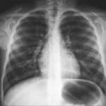 Chest X-Ray procedure at DCDC Dubai Healthcare City