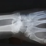 Hand/Wrist X-Ray procedure at DCDC Dubai Healthcare City