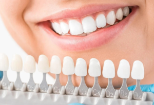 Read more about the article Revamp Your Smile Without the Drill: The Magic of Composite Veneers