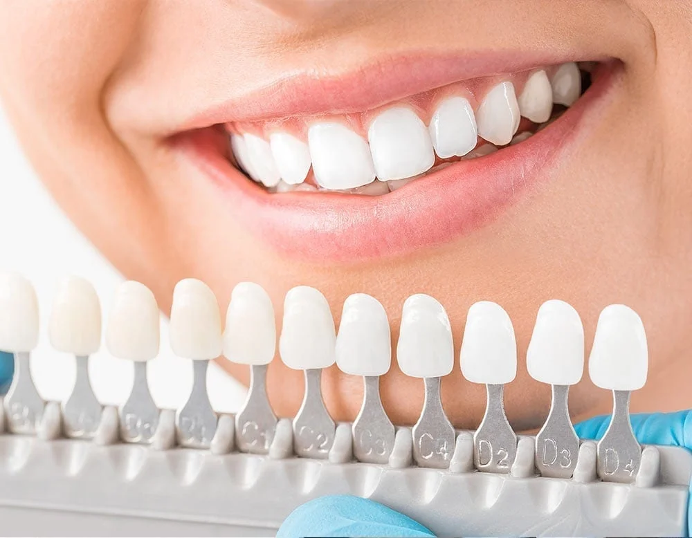 You are currently viewing Revamp Your Smile Without the Drill: The Magic of Composite Veneers