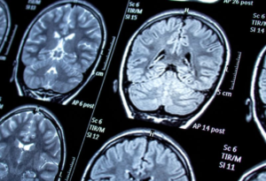 Read more about the article Comprehending Seizures: Origins, Signs, and Management