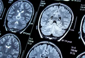 Read more about the article Comprehending Seizures: Origins, Signs, and Management