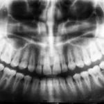 Teeth X-ray