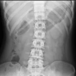 Abdomen X-ray