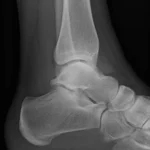 Ankle X-ray