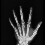 Hand X-ray
