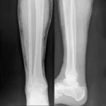 Legs X-ray
