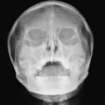 Sinus X-ray
