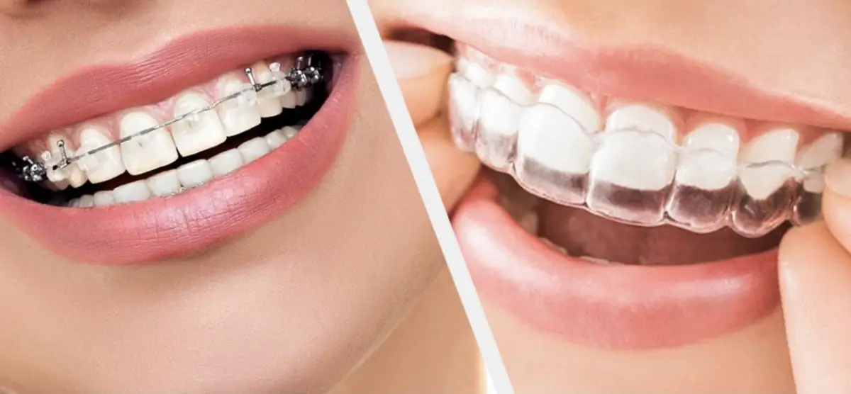 Invisalign Dubai: Cost, Timeline & Results (2026)