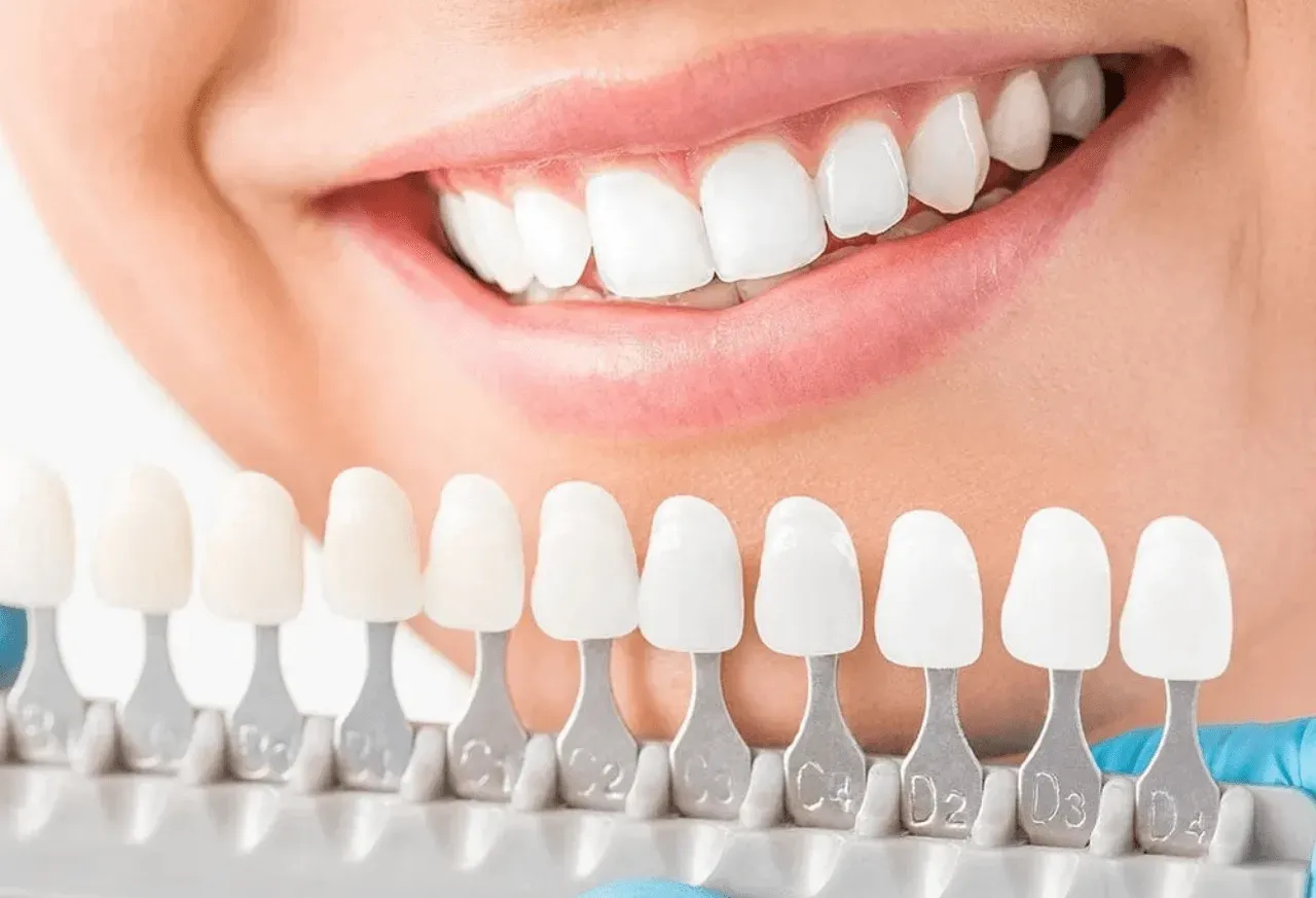 Ceramic Braces Dubai: Cost & vs Metal (2026)