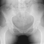 Digital hip X-ray showing hip joint and femoral head at DCDC Dubai Healthcare City